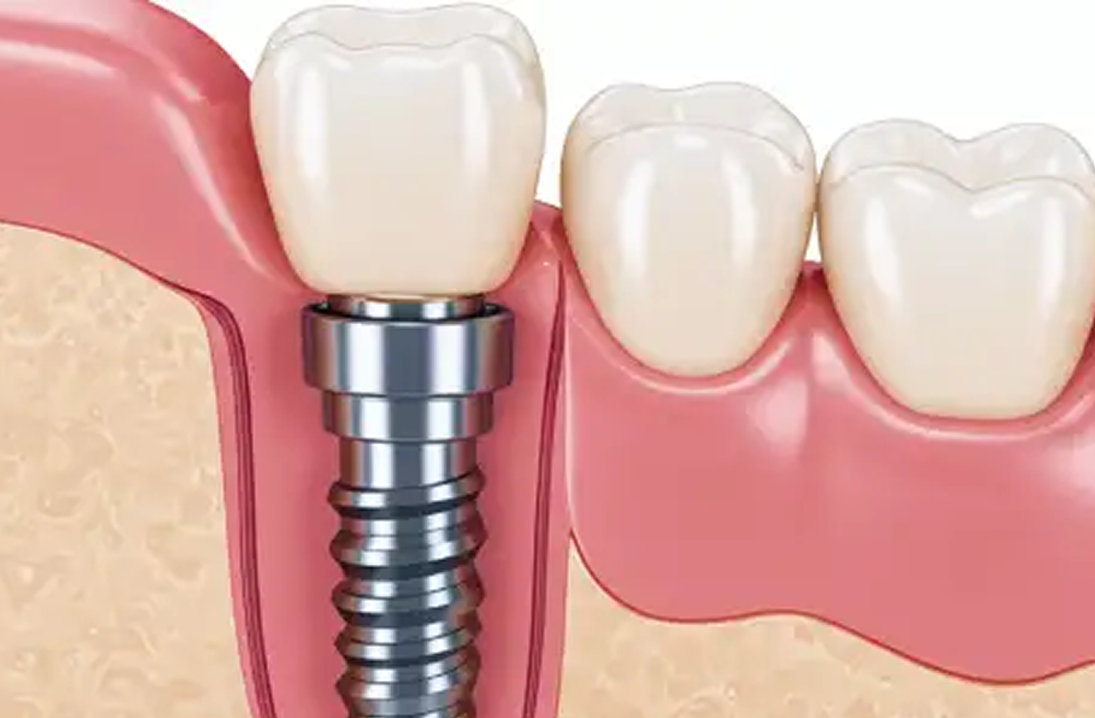 歯ぐきに埋入されたインプラントと人工歯の構造イメージ