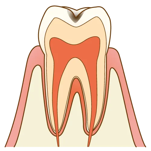 C1(初期むし歯)でエナメル質が溶け始めた歯の断面図