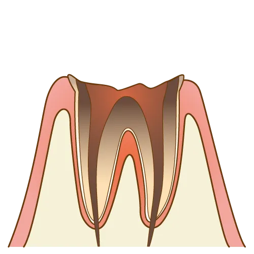 C4(重度のむし歯)で歯の大部分が崩壊した歯の断面図