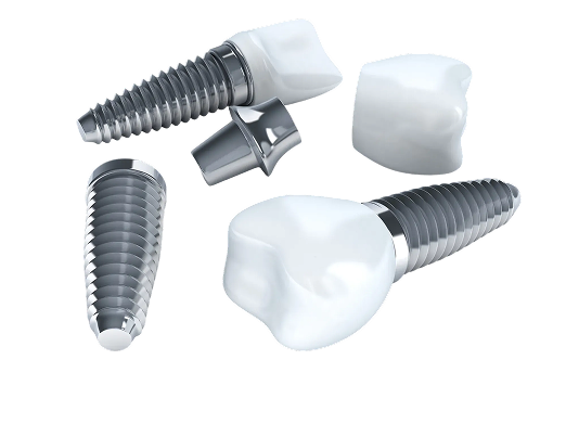 インプラントの構造を示したイメージ