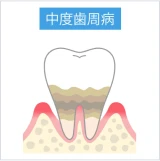 中等度歯周病で歯周ポケットが深くなり骨吸収が進行した歯の断面図