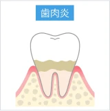 歯肉炎(初期段階)で歯ぐきに炎症が起きている状態の歯の断面図