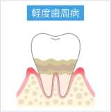 軽度歯周病で歯ぐきと歯槽骨に炎症が及び始めた歯の断面図