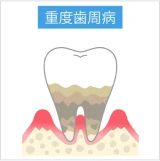 重度歯周病で歯槽骨の吸収が大きく進行した歯の断面図